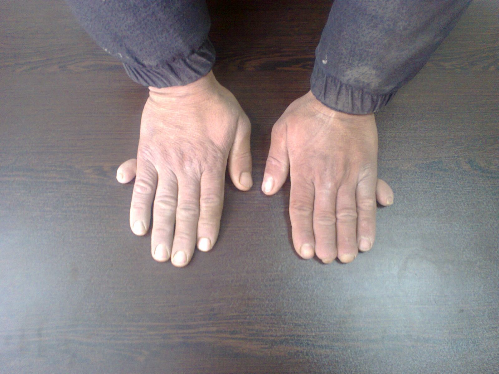 دستهای مرد شش انگشتی کاشمری